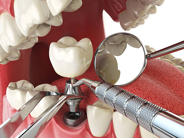 Best Emergency Wisdom Teeth Removal in Wantagh, NY